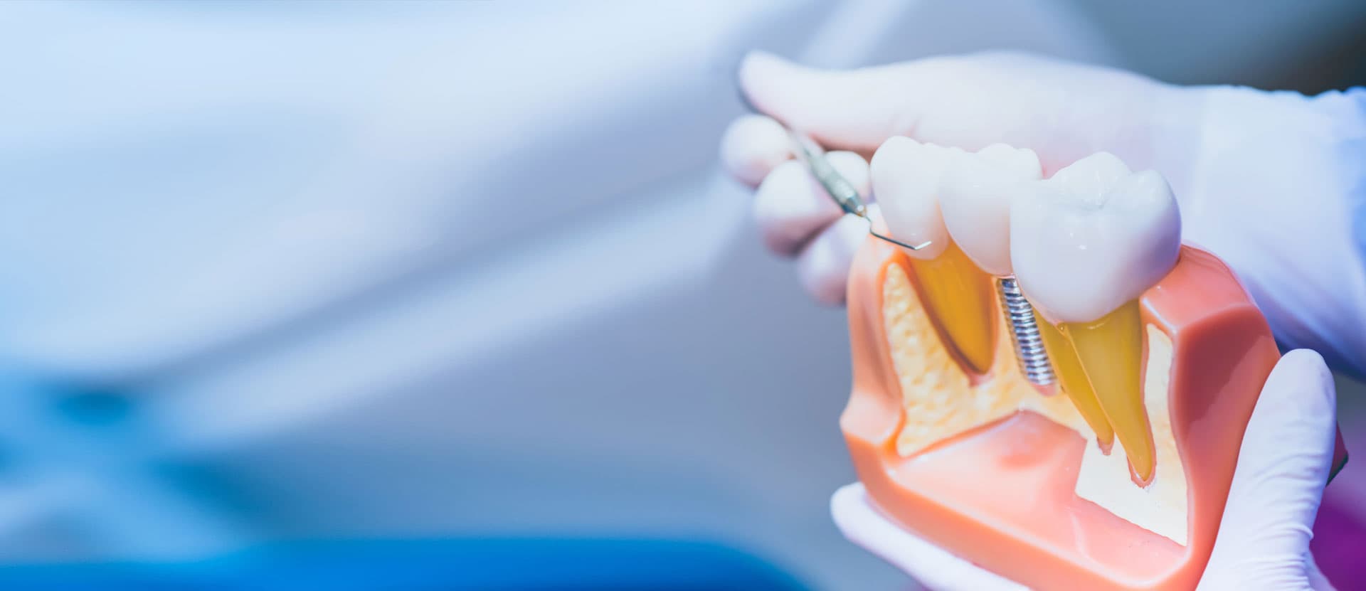 Implantes dentales en Pontevedra al mejor precio