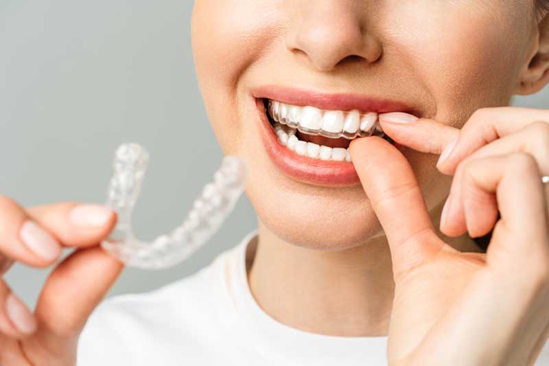 Invisalign